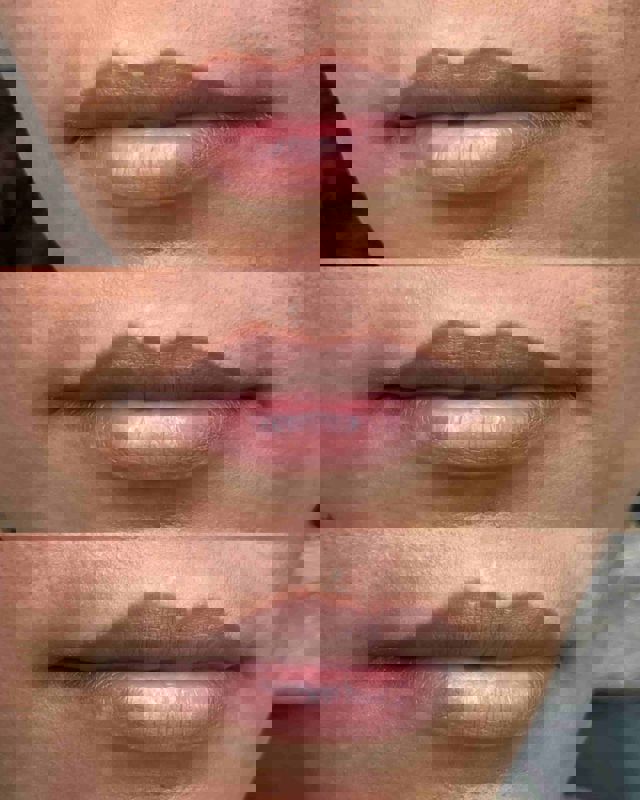 رفع کبودی لب 860